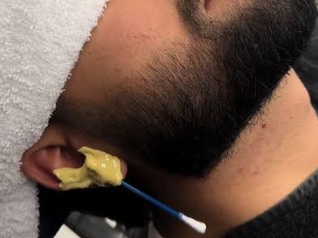 Depilação de Orelha